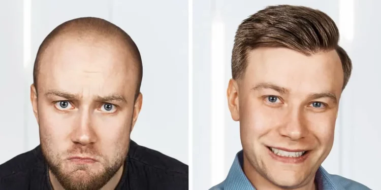 hair transplant