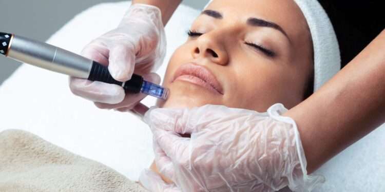 Microneedling Treatment